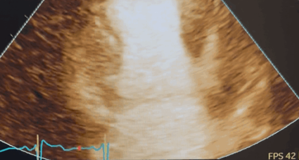Stress Echocardiography